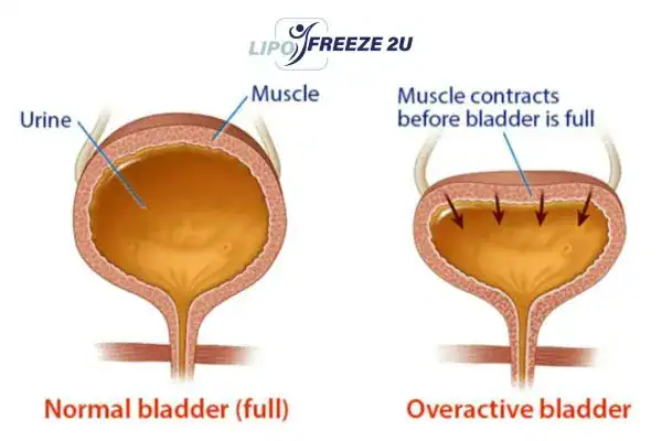 diagram of overactive bladder treatment Borehamwood
