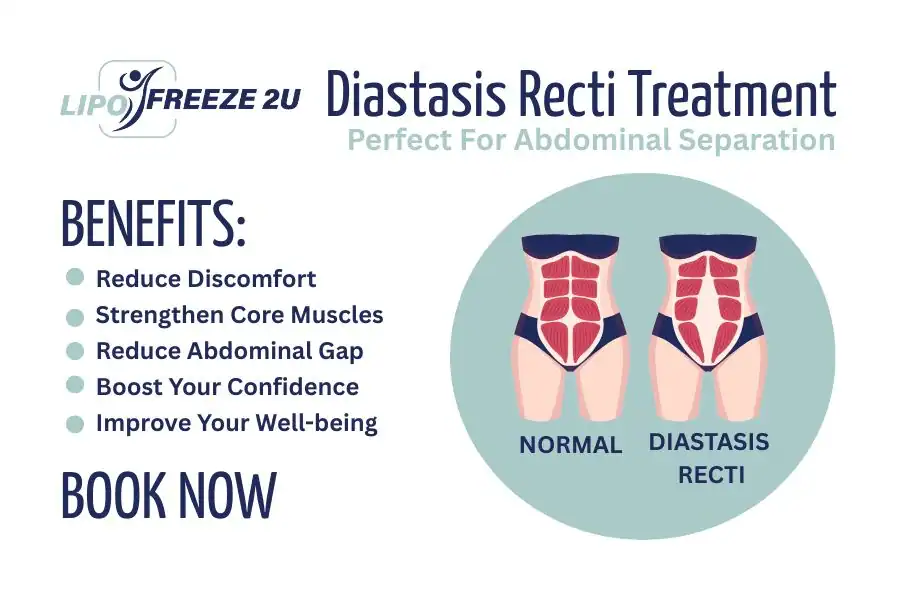 How Long Will It Take to See Improvements in Diastasis Recti Borehamwood