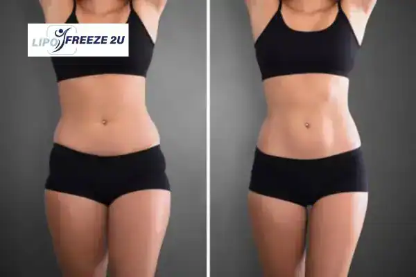 How Can LIPO FREEZE 2U Support Your Post-Pregnancy Body Recovery Borehamwood?