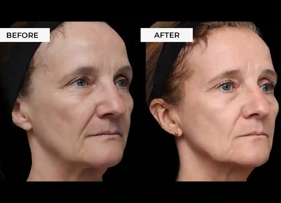 How Many RF Microneedling Sessions Will You Need to See a Difference Borehamwood?