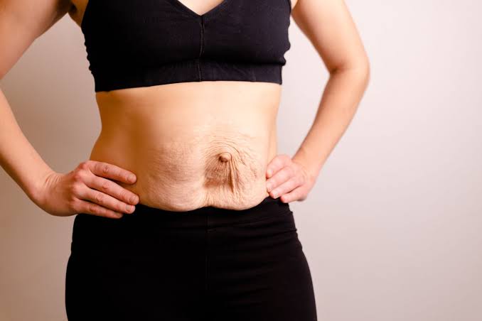 Is Surgery Really the Only Way to Repair Diastasis Recti Borehamwood?